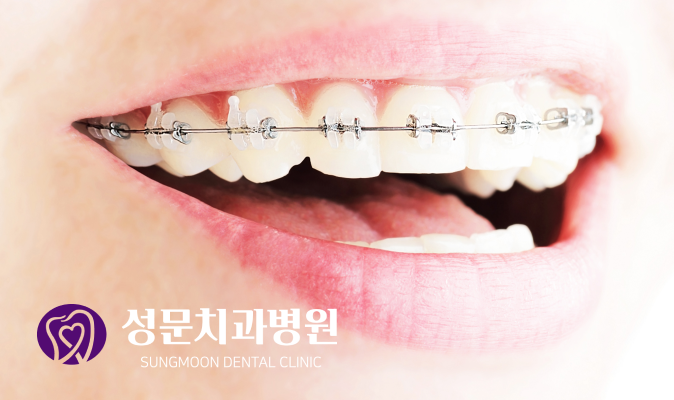 비수술 비발치 치아교정