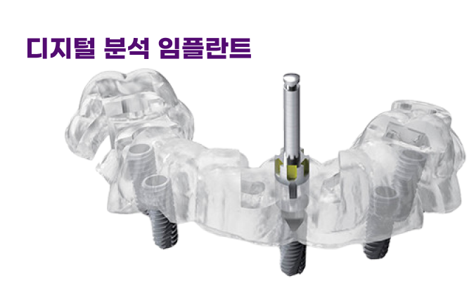 고난도 식립도 안전하게 디지털 분석 임플란트
